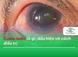 Cườm nước là gì?