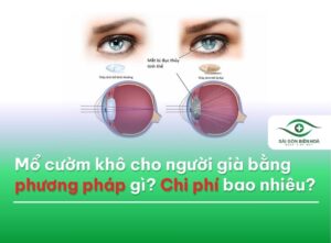 Mổ cườm cho người già chi phí bao nhiêu